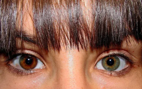 Heterochromia having two different eye colors